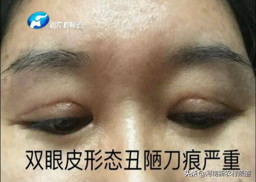 最新雙眼皮手術(shù)費用,最新雙眼皮手術(shù)費用詳解